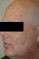 Age Spot Removal Long Beach, CA Before and After Photos