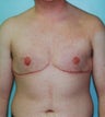41-Year-Old Male Breast Reduction