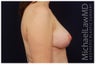 Breast Lift