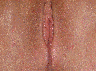Vaginoplasty