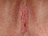 Vaginoplasty