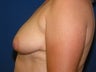 Breast Lift