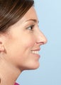 Woman Treated for Weak Chin