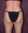 Tummy tuck (abdominoplasty) with liposuction of hips