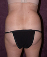 Tummy tuck (abdominoplasty) with liposuction of hips