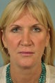 Upper and Lower Eyelid Surgery