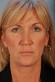 Upper and Lower Eyelid Surgery