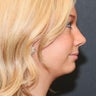 Chin Augmentation