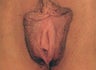 Vaginal Rejuvenation & Labiaplasty