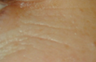 Laser Genesis