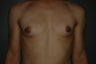 MTF trangender breast augmentation. Submuscular textured, shaped silicone implants. Incision under breast.
