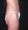 Liposuction