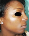 36 year pld female treated with Rhinoplasty