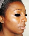 36 year pld female treated with Rhinoplasty