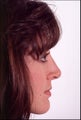 Rhinoplasty