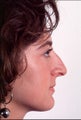 Rhinoplasty