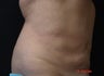 Coolsculpting