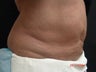Coolsculpting