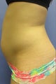 Liposuction to Upper Abs, Lower Abs and Waist