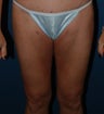 Liposuction Inner Thighs