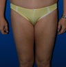 Liposuction Inner Thighs