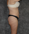Vaser Liposuction