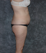 Vaser Liposuction