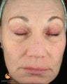 Female treated with 3 Photodynamic Therapy with Levulan for sun damage