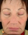 Female treated with 3 Photodynamic Therapy with Levulan for sun damage