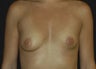 Breast Asymmetry