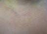 Scar Revision Procedure for Thyroid Keloid Scar on the Neck and Chest
