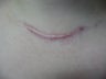 Scar Revision Procedure for Thyroid Keloid Scar on the Neck and Chest