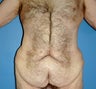 male abdominoplasty