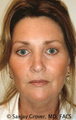 Facelift