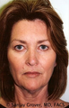 Facelift
