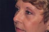 Active FX and Lower Eyelid Blepharoplasty