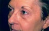 Active FX and Lower Eyelid Blepharoplasty