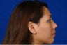 Barrera rhinoplasty hispanic hump nose