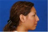 Barrera rhinoplasty hispanic hump nose