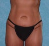 Circumferential Body Lift with Buttock Augmentation