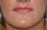 Lip Lift