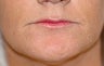 Lip Lift