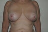 Vertical breast reduction/mastopexy