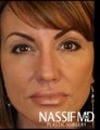 Female Revision Rhinoplasty