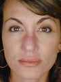 Female Revision Rhinoplasty