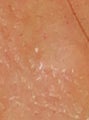 Cosmetic Mole Removal