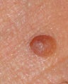 Cosmetic Mole Removal