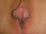 Vaginal Rejuvenation