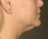 Ulthera