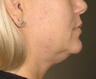 Ulthera
